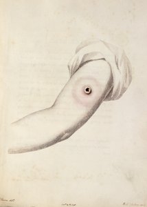 Pustule de vaccine sur un bras, tirée de 